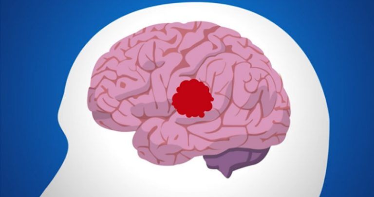 (Vídeo) Famosos que han superado un Ictus