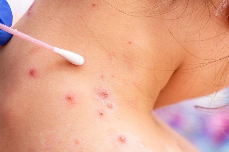 Ya son siete los casos sospechosos de viruela del mono en la provincia de Málaga