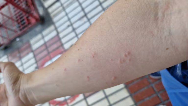 Plaga de pulgas o chinches en el hospital Regional de Málaga